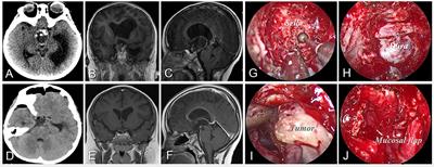 Extended Neuroendoscopic Endonasal Approach for Resection of Craniopharyngioma in Children